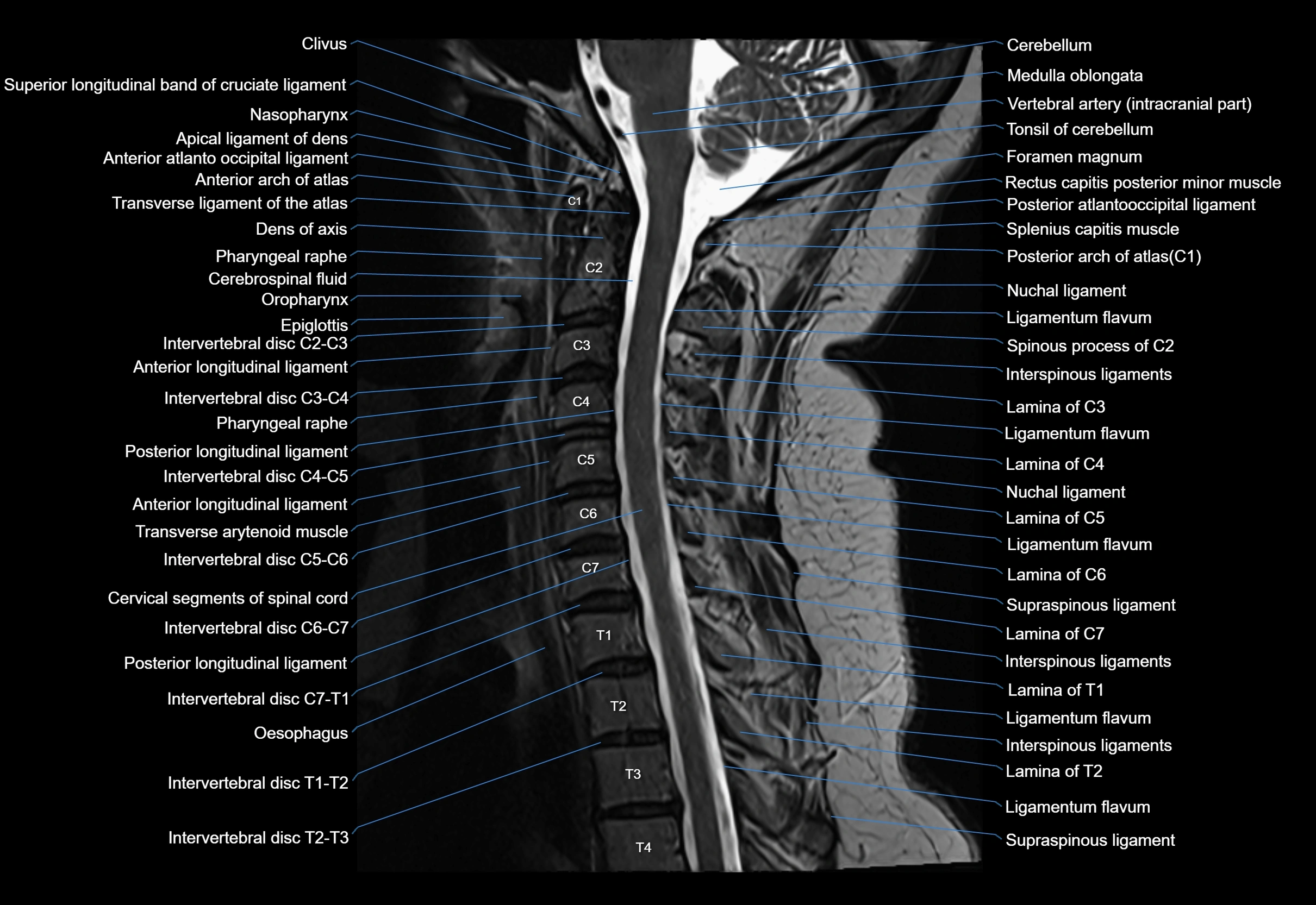cervical spine cross sectional MRI anatomy 3T MRI  sagittal image-img-00001-00018.webp